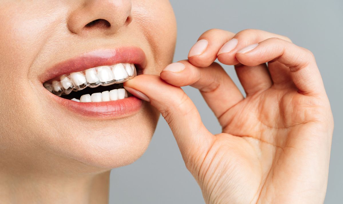Invisalign Aligners