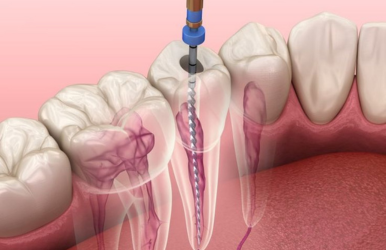 Clear Aligners