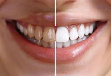 Professional Teeth Whitening
