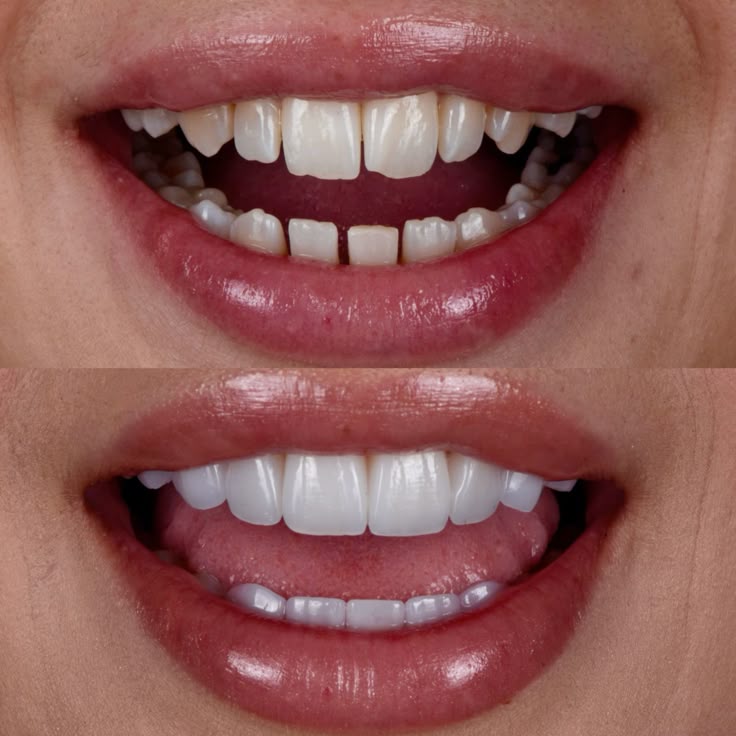 Tooth Extractions